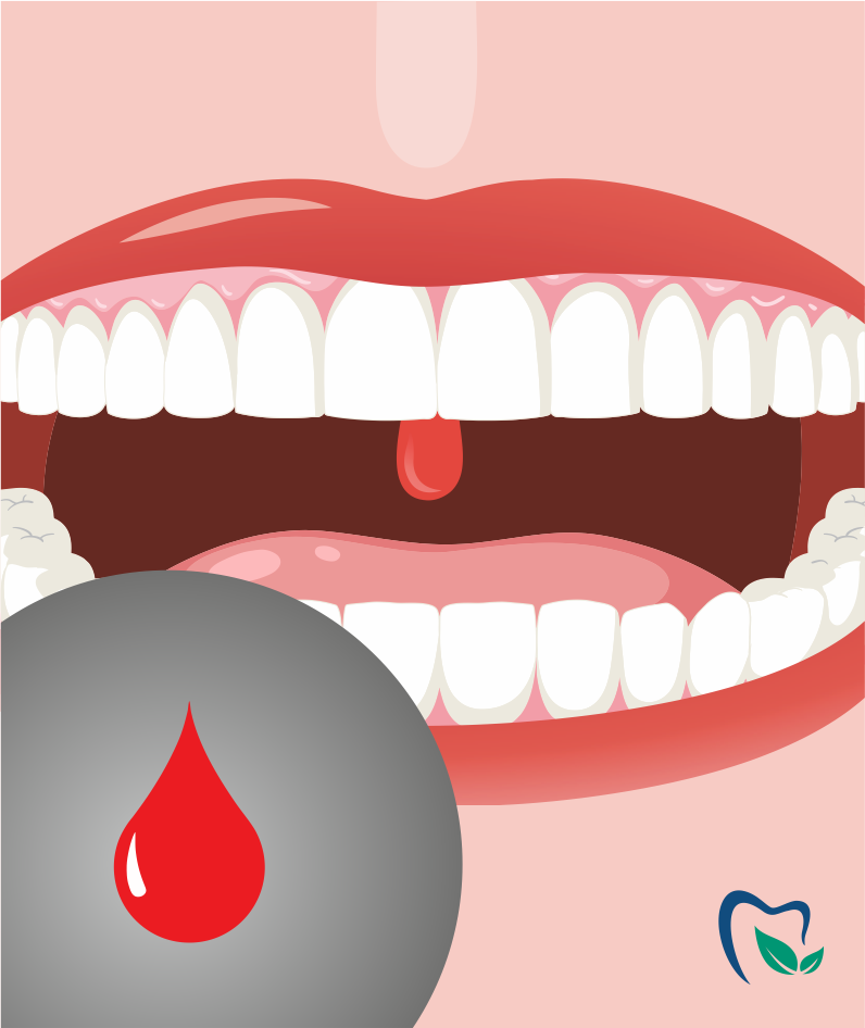 Можно ли удалять зуб при менструации?
